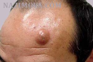 usl-laser-ateroma2.jpg usl-laser-ateroma2.jpg