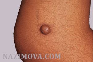 usl-laser-dermatofibroma.jpg usl-laser-dermatofibroma.jpg