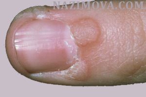 usl-laser-borodavka-nogot.jpg usl-laser-borodavka-nogot.jpg