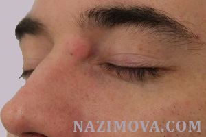 usl-laser-ateroma1.jpg usl-laser-ateroma1.jpg