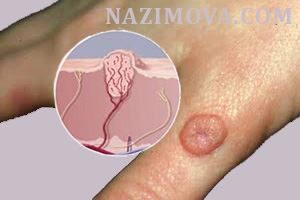 usl-laser-borodavka-ruka.jpg usl-laser-borodavka-ruka.jpg