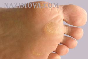 usl-laser-mozoly-gor.jpg usl-laser-mozoly-gor.jpg