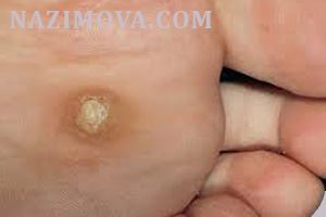 usl-laser-borodavka-podosh1.jpg usl-laser-borodavka-podosh1.jpg