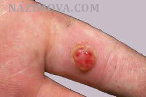 usl-laser-gramulema.jpg usl-laser-gramulema.jpg